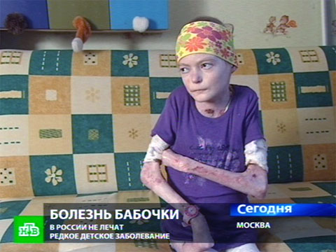 болезнь эффект бабочки фото онлайн болезнь эффект бабочки фото