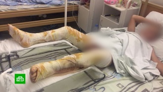 Нижегородские подростки в шутку подожгли восьмилетнего школьника